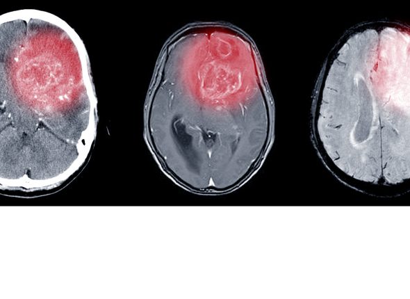 CT and MRI Brain scan.